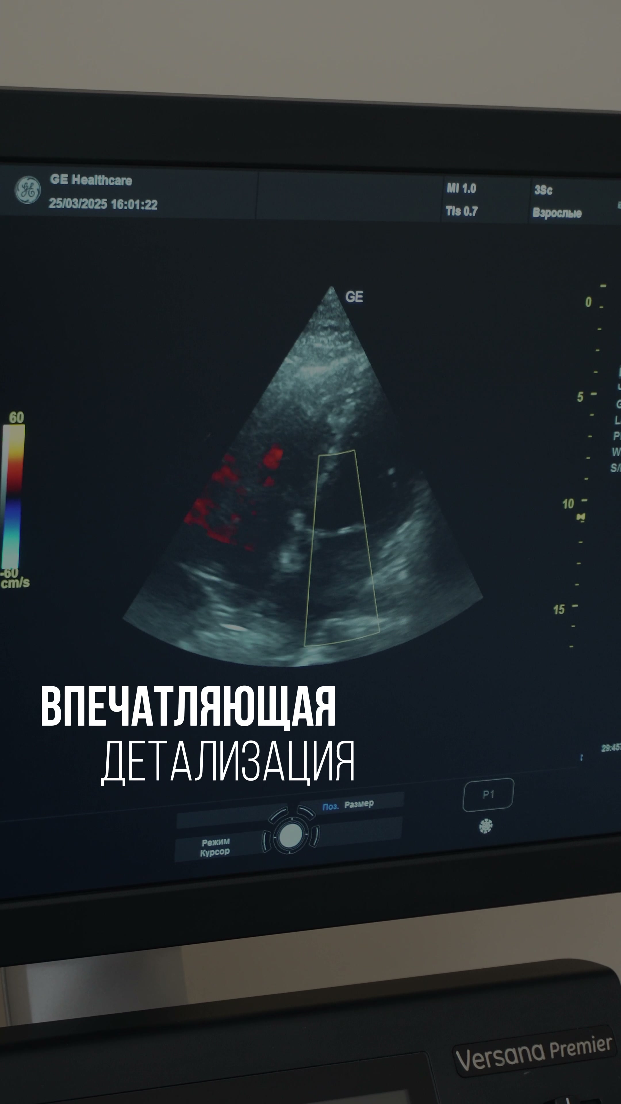 Versana Premier — демонстрация УЗИ-аппарата — кадр из видео